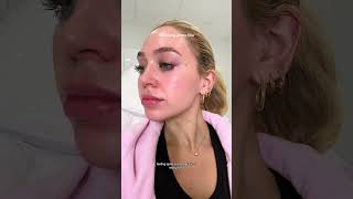 Dissolving my Lip Filler 💗 vlog lipfiller [upl. by Chaddy]