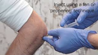 Injection Technique for Lateral Epicondylalgia [upl. by Raila825]