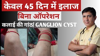 Homeopathy For Ganglion Cysts  A Natural Drugfree Way To Treat These Growths [upl. by Aromat]