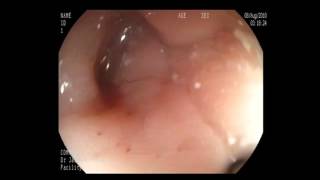 gastric outlet obstruction [upl. by Jp]