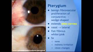 Pterygium vs Pinguecula quotEM in 5quot [upl. by Idelia]