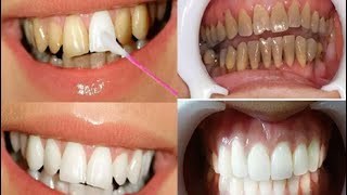 JEITO FÁCIL E BARATO para remover o tártaro e deixar os dentes BRANCOS [upl. by Deste935]