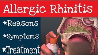 Best treatment for allergies Rhinitis Dr Health Officials [upl. by Warrick283]