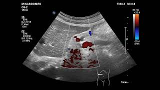 ESRD on HDendstagerenaldisease on hemodialysis [upl. by Packer]