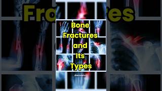 Bone Fractures amp its Common Types  Anatomy Video fracture bonefracture physio anatomy shorts [upl. by Alane502]