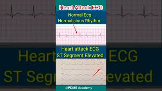 ECG changes During Heart Attack medicine ecg [upl. by Adolfo]