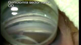 Goniotomy in Congenital Glaucoma  Dr Mauricio Turati Acosta [upl. by Birecree]