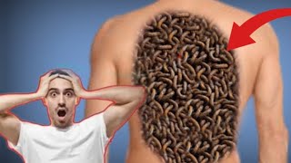 How to Remove Worms Infected From Man PAIN  easily cut off [upl. by Oivalf763]