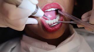 How teeth cleaning is done   DENTAL SCALING  FMS DENTAL HOSPITALS [upl. by Plantagenet]