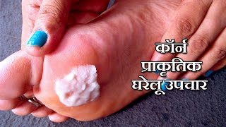 कॉर्न के उपचार  Corn Treatment in Hindi  corn ka ilaj  corn treatment at home [upl. by Asset]