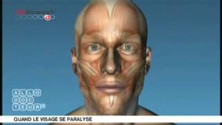 paralysie faciale explications [upl. by Lindemann886]