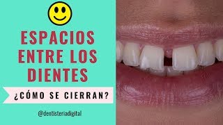 Espacios entre los dientes ¿Cómo cerrarlos Ortodoncia o Diseño de Sonrisa [upl. by Yrffej]