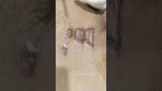 Keloid Scar Intera lesional Kenacort Steroid Injection Procedure ortho shorts injection keloid [upl. by Seabury239]