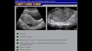 Ultrasound Course of Gynecology Part 01 [upl. by Dutchman]