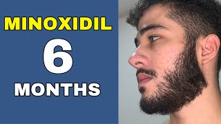 Minoxidil Beard Journey 6 MONTHS TRANSFORMATION [upl. by Beulah]