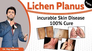 LICHEN PLANUS  Signs and Symptoms  How to Diagnose  Management  Urdu  Hindi  InqalabFareed [upl. by Kcirdot]