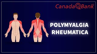 Polymyalgia Rheumatica [upl. by Akelahs]