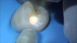 Video Case Study Class II Procedure Using the Solea Dental Laser [upl. by Aramenta]