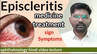 Episcleritis treatment  Episcleritis disease in eye  sclera anatomy  Episcleritis  optometry [upl. by Yort396]