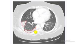 USMLE World step 2 ck  Pulmonary  part 1 شرح أسئلة [upl. by Musa228]