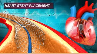 Angioplasty for Narrowing Heart Arteries  Heart Stent Placement  Stent 3D Animation [upl. by Aihsela]