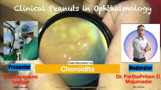 Case discussion on Choroiditis [upl. by Jaymee]