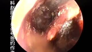 Earwax Removal Extractions White Mold Earwax Suck out 白色霉菌耳屎 外耳道挖耳屎清理 耳垢 耳垢 [upl. by Kerrie]