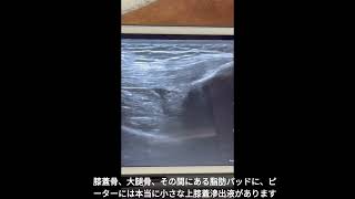 Handheld ultrasound devices for hemarthrosis  Japanese Subtitled [upl. by Ailedo]