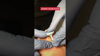 How dermatologists remove moles shorts [upl. by Obadiah807]