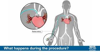 Coronary Angiogram Procedure [upl. by Lynnea446]