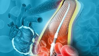 How Angioplasty Procedure Is Performed  Balloon Angioplasty And Coronary artery stent Procedure [upl. by Eziechiele]