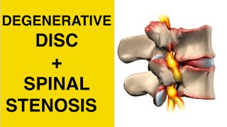 Sciatica Exercises  Stretches for Spinal Stenosis amp Degenerative Disc Disease Treatment [upl. by Elleneg]