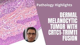 Pathology highlights  Dermal melanocytic tumor CRTC1 [upl. by Etiuqal]