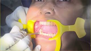 Mandibular Right First Molar Extraction dentistrydentist trending youtube oralsurgery [upl. by Aziaf]