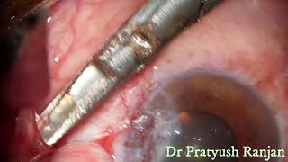 Pterygium Surgery Bare Sclera Method with post op 005 Cyclosporin Drops [upl. by Onilatac]