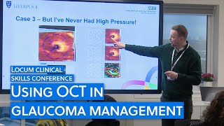 How to use OCT for glaucoma management [upl. by Bennett]