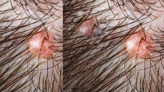 Ingrown hair removal 03 [upl. by Redman]