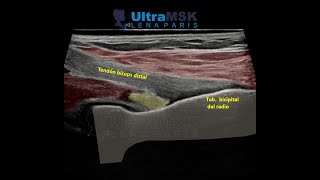 ¿Como evaluar la porción distal del bíceps en ultrasonido [upl. by Tilden967]