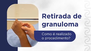 Retirada de granuloma  Como é realizado o procedimento [upl. by Igenia883]