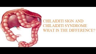 Chilaiditi Syndrome [upl. by Anivlem]