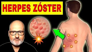 HERPES ZÓSTER Culebrilla Causas Síntomas y Soluciones [upl. by Mosora407]