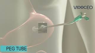 Percutaneous Endoscopic Gastrostomy PEG feeding tube animated explanation [upl. by Broek]