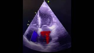 cardiology echocardiography heartdisease echo heartcondition SafaMedicalLecture [upl. by Oidiple835]