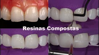 RESTAURAÇÕES EM RESINAS COMPOSTAS PARA DENTES DESGASTADOS [upl. by Cherry79]