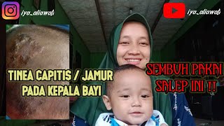 Cara Mengobati Tinea Capitis  Jamur Pada Kepala Bayi [upl. by Morris]