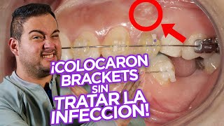 ¡BRACKETS Ortodoncia con DIENTES con ENDODONCIA TRATAMIENTOS DE CONDUCTO ¿SE PUEDE ¡CASO REAL [upl. by Sitoiganap710]