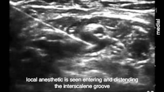 Periplexus Interscalene Brachial Plexus Block In Plane Approach [upl. by Ahsakal833]