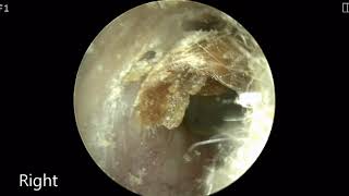 ep2 Ear wax removal [upl. by Anailli]