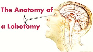 The Anatomy of a Lobotomy  What is a Lobotomy Explained  Anatomy of the Brain A Deep Dive [upl. by Nelyt]