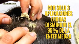 Remedio Casero para Psoriasis  Dermatitis Seborreica  Seborrea  Caspa [upl. by Nalyad]